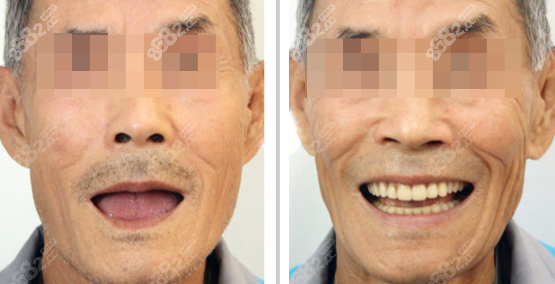 宁波拜博口腔全口种植牙效果图