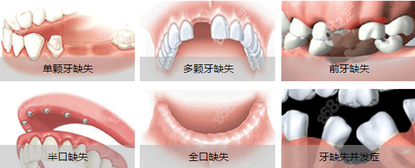 种牙医生临床操作经验丰富,手阅案例无数,可以解决高难度种植病例1