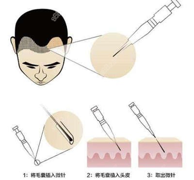 毛囊取出过程