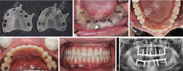 广州德伦口腔医院全口种植牙案例