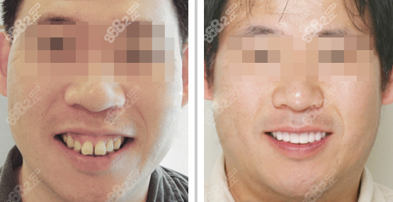 宁波拜博口腔龅牙戴隐形牙套矫正效果图
