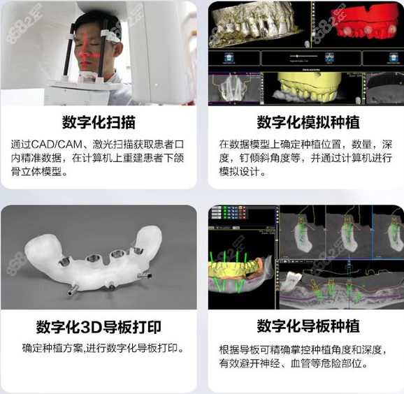 广州德伦口腔医院种牙优势