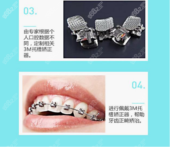美国牙套品牌3M