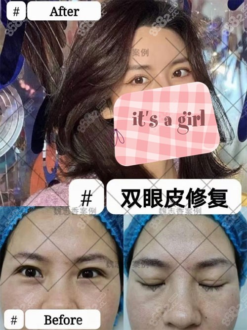 魏志香醫(yī)生雙眼皮<span style= 魏志香醫(yī)生雙眼皮<span style=