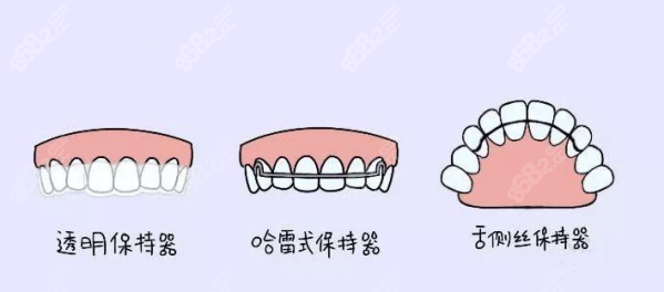 矫正牙齿需要配套的几种保持器