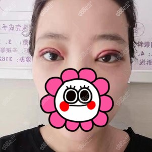 找<!--<i data=20240705-sp></i>-->做双眼皮修复术后3天