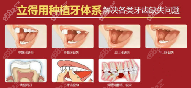 西安中诺口腔立得用种植技术