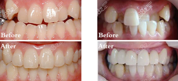 重庆牙博士矫正牙齿案例