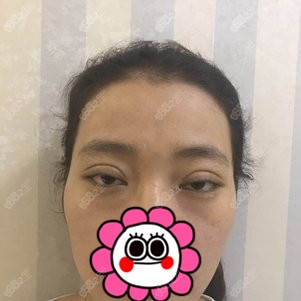 找<!--<i data=20240705-sp></i>-->做双眼皮修复前