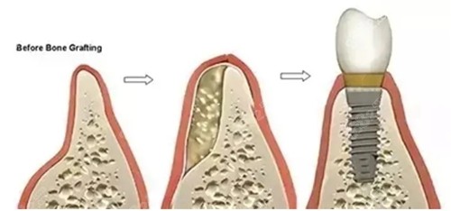 填充骨粉的种植牙