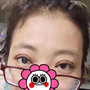 找<!--<i data=20240705-sp></i>-->做双眼皮修复术后1个月