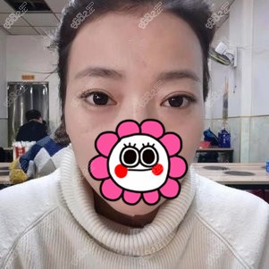找<!--<i data=20240705-sp></i>-->做双眼皮修复术后半年