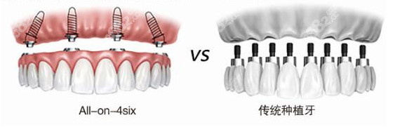 All-on-4种植技术