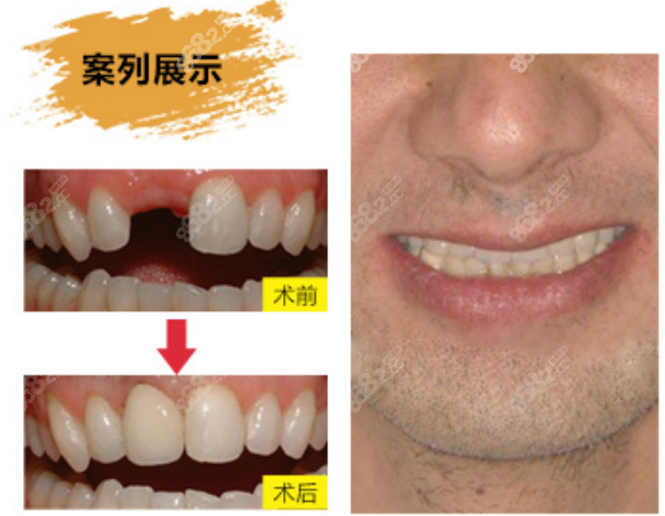 广州好大夫口腔奥齿泰矫正案例