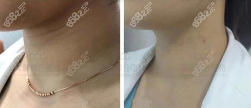 <!--<i data=20240705-sp></i>-->嗨体去颈纹效果图