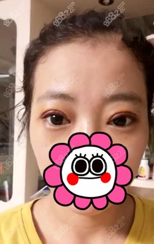 找<!--<i data=20240705-sp></i>-->做双眼皮修复术后10天
