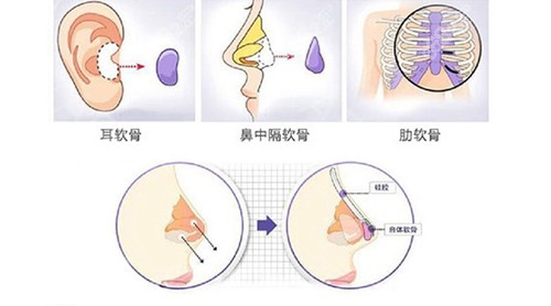 爱丽诺隆鼻技术特色