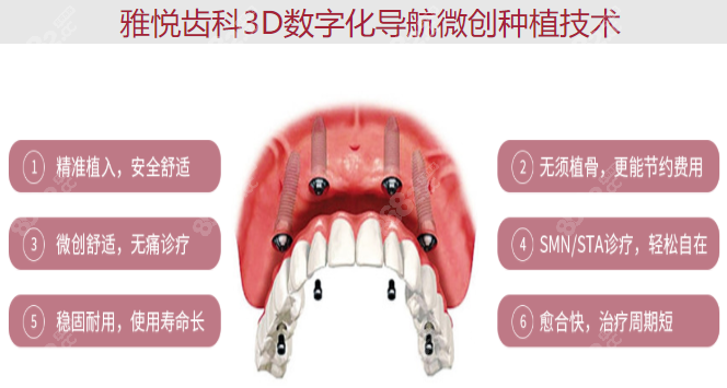 上海雅悦齿科做种植牙的技术怎么样