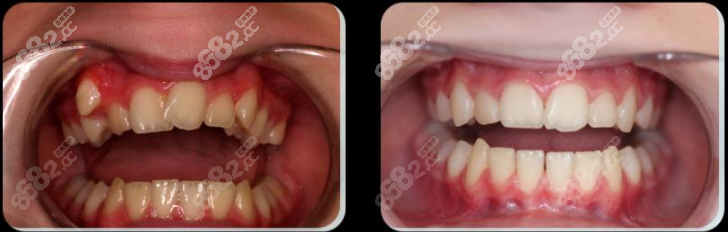 多生牙/牙齿歪斜矫正案例图