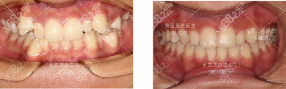 张栋梁医生I度深覆隐形矫正效果图