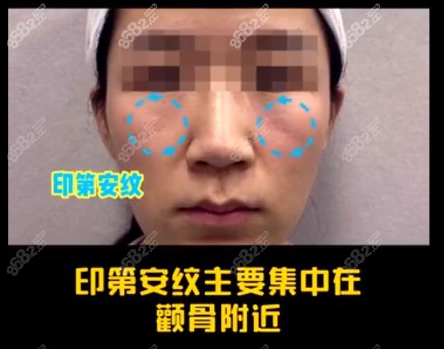 如何去除印第安纹?北京李晓东PST面部提升轻松改善效果持久