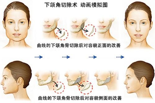 下颌角切除术过程