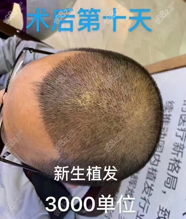 上海新生毛发医院好不好?通过种植案例来看看医院的植发效果吧!