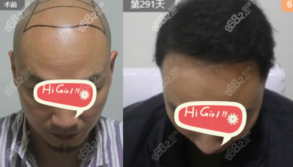 武汉<!--<i data=20240705-sp></i>-->植发案例