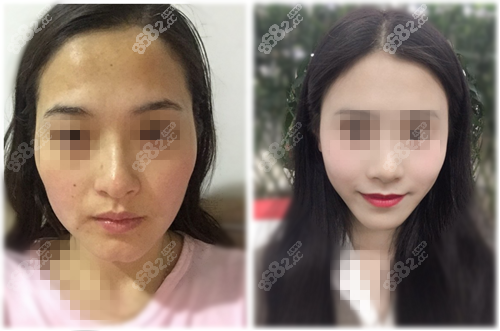 顴骨高做顴骨內(nèi)推案例前后對比圖展示