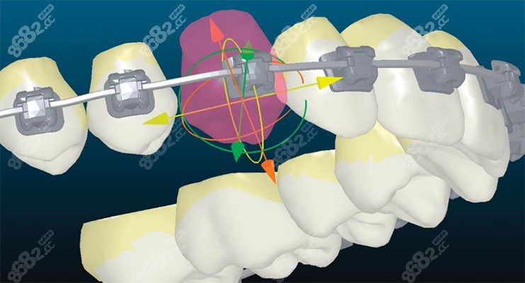 金属牙齿矫正器作用力