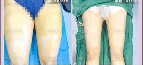 海南華美5G維密脂雕瘦大腿真人前后對(duì)比照 海南華美5G維密脂雕瘦大腿真人前后對(duì)比照