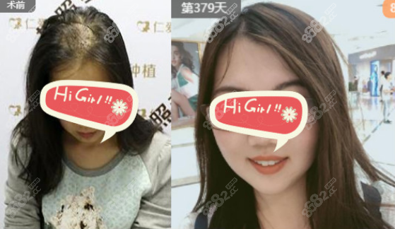 <!--<i data=20240705-sp></i>-->植发植发专科医院植发案例一