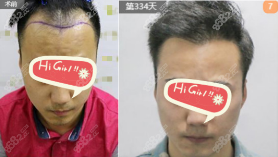 <!--<i data=20240705-sp></i>-->植发植发专科医院案例二