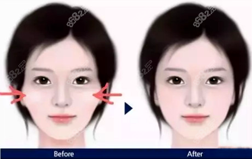 顴骨高做做顴骨內(nèi)推好還是脂肪填充好