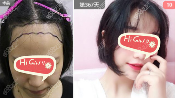 <!--<i data=20240705-sp></i>-->微针植发案例