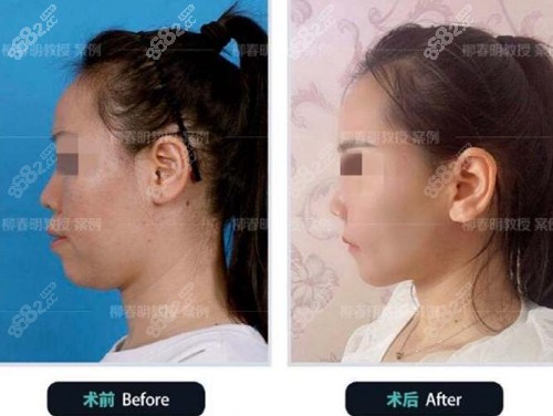 北京联合丽格柳春明正颌手术前后对比图