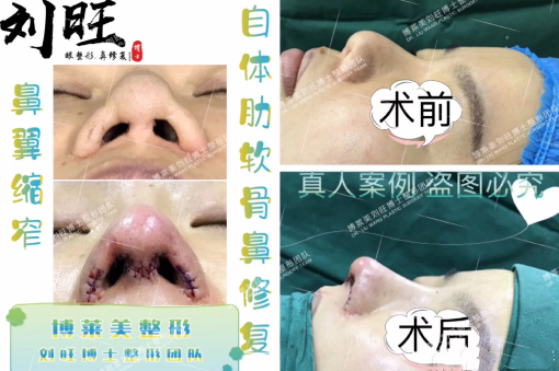 天津博莱美刘旺做鼻子效果图，含肋骨隆鼻和挛缩鼻修复图