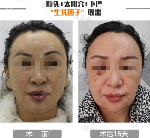 <!--<i data=20240705-sp></i>--><!--<i data=20240705-sp></i>-->生長因子取出真人案例