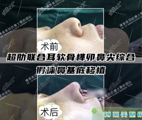 刘旺医生超肋+耳软骨鼻综合效果图