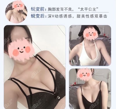 曼托假体丰胸图