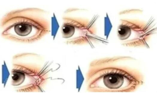 外眼角缝合修复方式过程解析