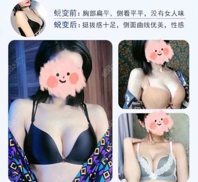 傲诺拉假体丰胸图