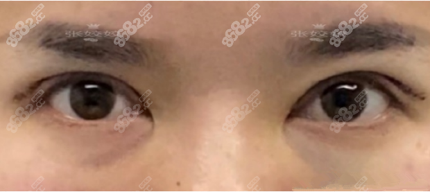 长沙爱思特张姣姣眼修复案例术后照