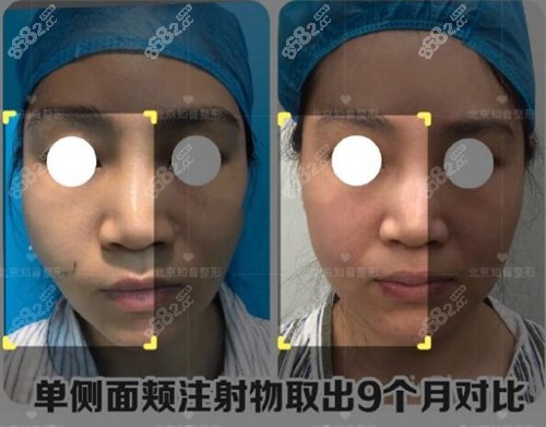 北京知音李奇軍面部注射物取出真人案例