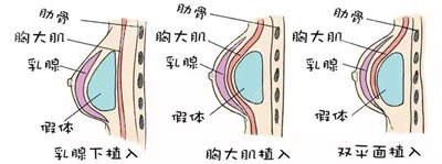 假体隆胸植入方法