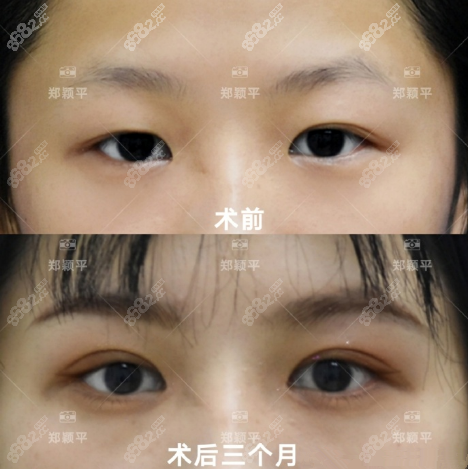 郑颖平双眼皮前后对比图1