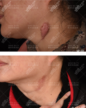颈部疤痕疙瘩1年治疗效果图