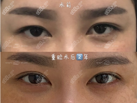 张姣姣双眼皮案例前后对比图2
