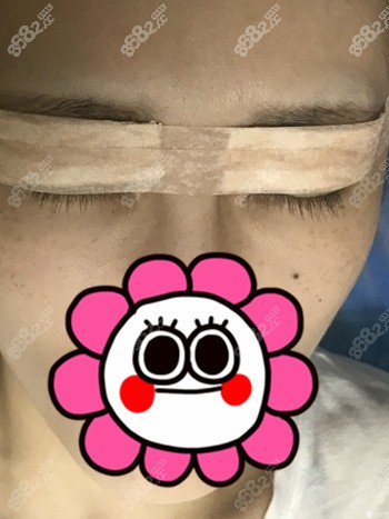 找上海何祥龙双眼皮修复术后2天