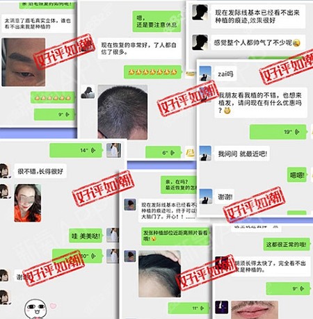 <!--<i data=20240705-sp></i>-->植發(fā)的口碑